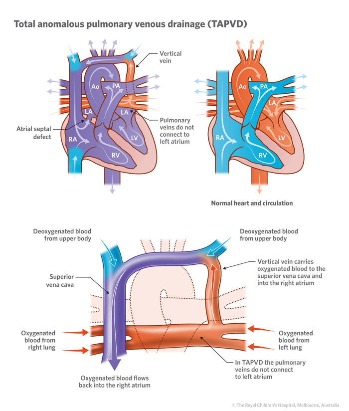 Total anomalous pulmonary venous drainage (TAPVD) | Children's Health ...