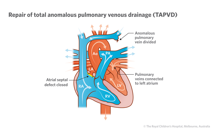 Illustration of a heart circulation when total anomalous venous drainage is repaired