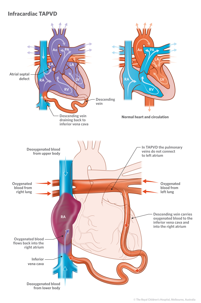 Illustration of an intracardiac total anomalous pulmonary venous drainage