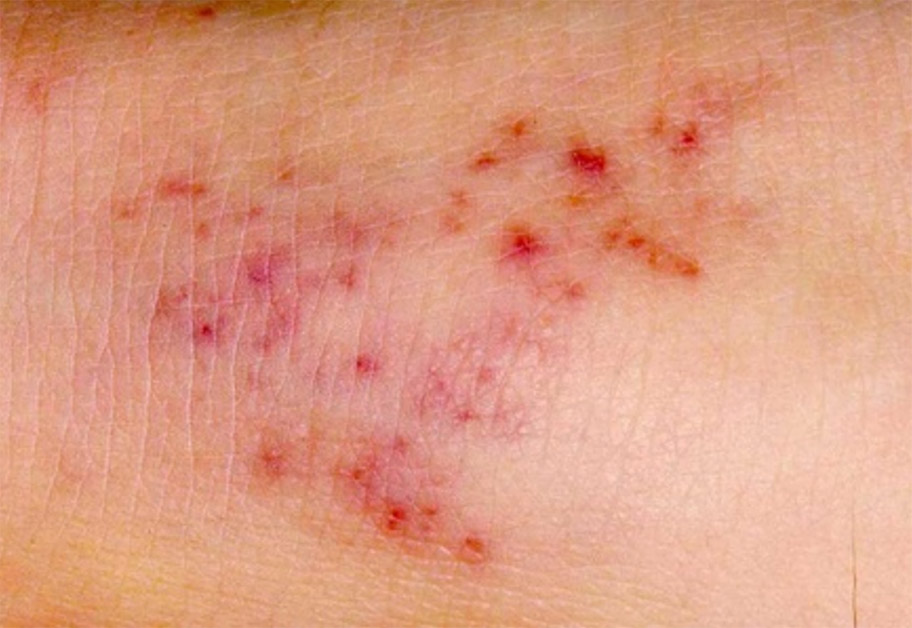 Rash case-4