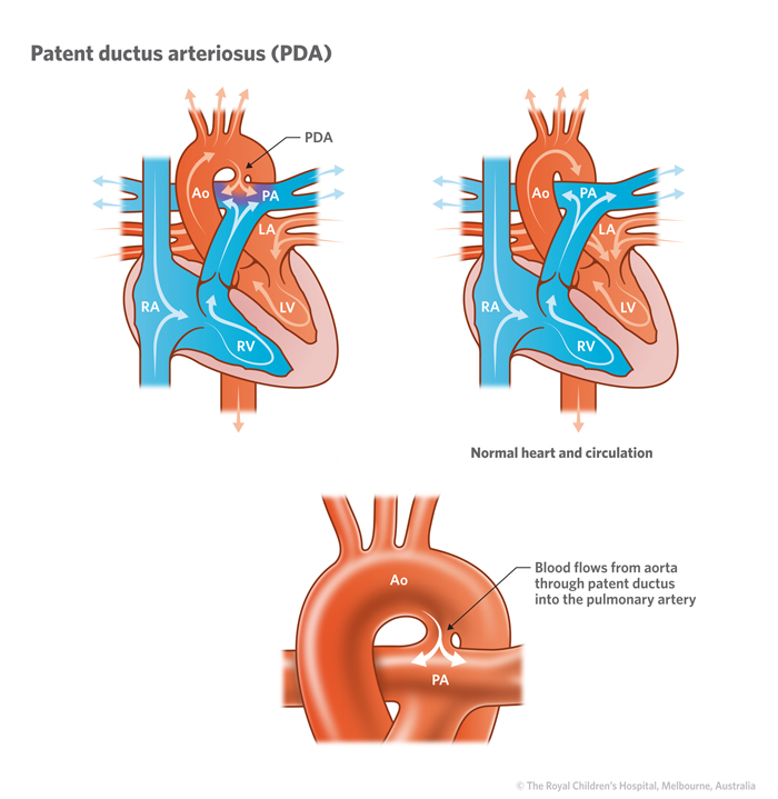 Patent ductus arteriosus (PDA) | Children's Health Queensland