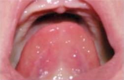 Photo of underneath of tongue showing normal curved shaped tongue.