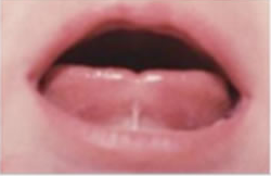 Photo of underneath of tongue showing skin connecting the underside of tongue to bottom of gum behind the teeth. This causes the tip of the tongue to have a slight v shape in its centre.