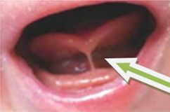 Photo of underneath of tongue showing skin connecting the underside of tongue to bottom of gum behind the teeth. This causes the tip of the tongue to have a distinct heart-shaped indentation at the tip of the tongue..