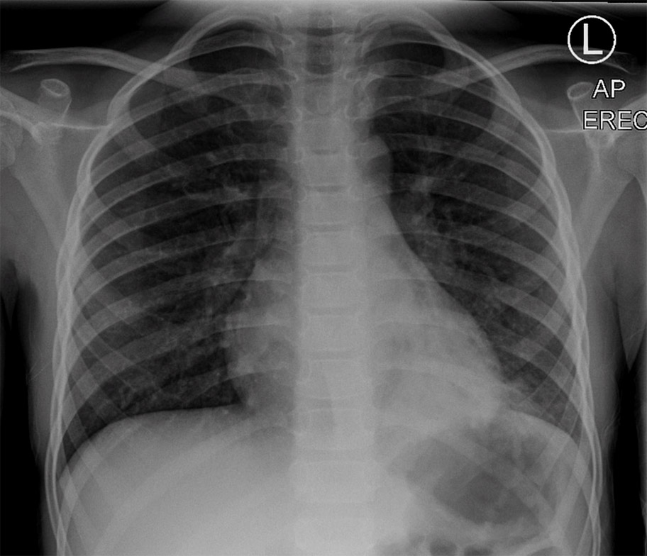 CXR 