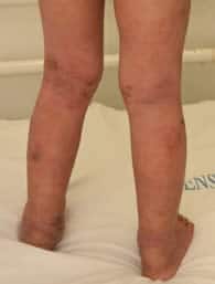 Eczema on legs of child aged 6 months to 12 years