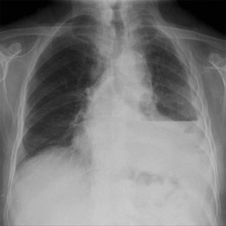 Repeat CXR