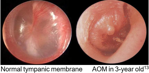 Normal tympanic membrane displayed next to Tympanic membrane of 3-year-old child with acute otitis media 