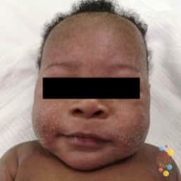 Eczema on face of child aged birth to 6 months