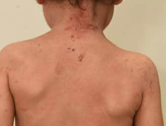 Eczema on back of child aged 6 months to 12 years