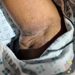 Lichenification on arm of child