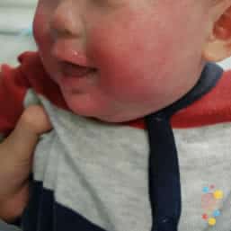 Eczema on face of child aged birth to 6 months