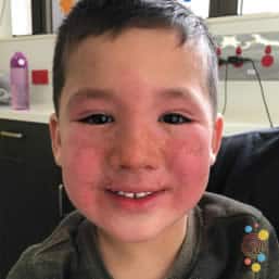 Impetiginised eczema on face of child