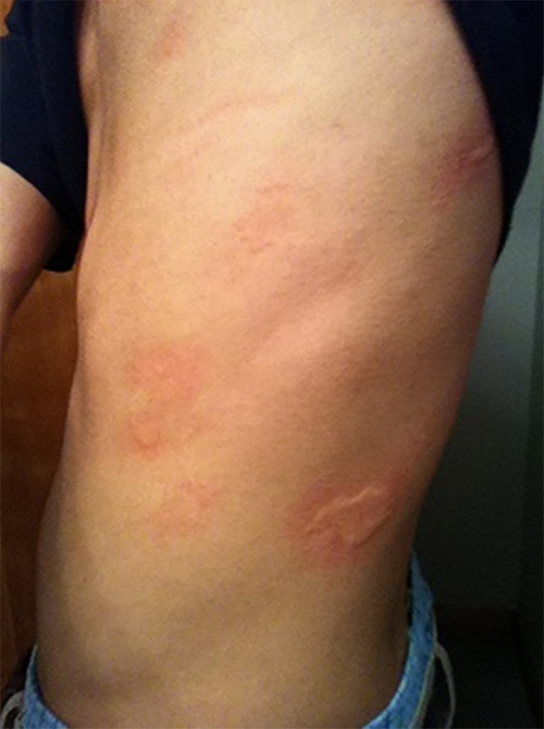 Rash