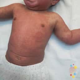 Eczema on body of child aged birth to 6 months