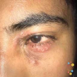 Eczema herpeticum on eye of child