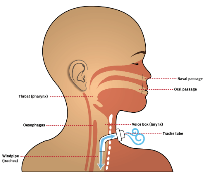 Illustration of a tracheostomy tube is inserted into the windpipe