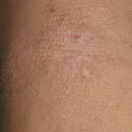 Eczema on skin of child aged over 12 years