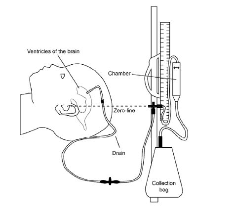 External ventricular drain diagram
