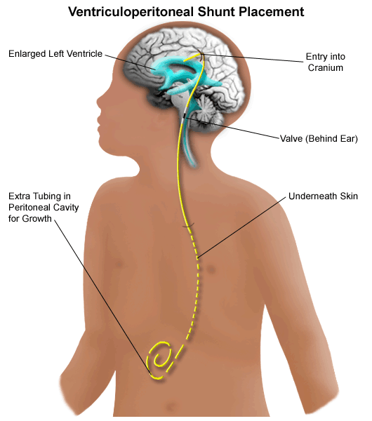 Diagram of a body showing the placement of a shunt and tubing from the brain to stomach cavity.