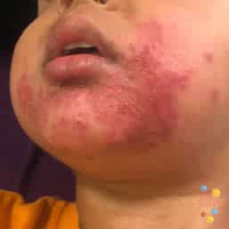 Eczema herpeticum on face of child