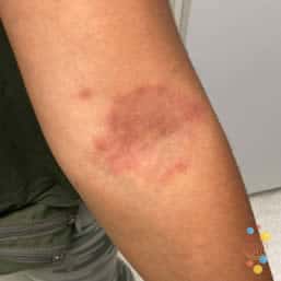 Eczema on arm of child aged 6 months to 12 years