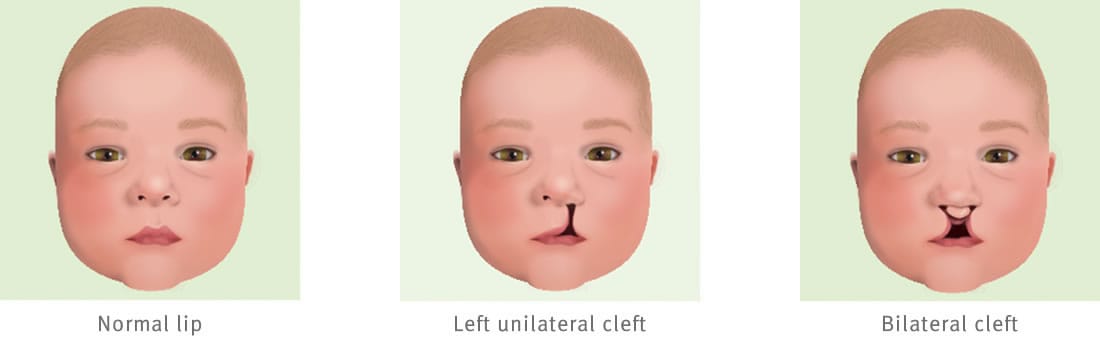A face with normal lips, a face with a left unilateral cleft that stretches from the top lip to nostril, and a face with a bilateral cleft stretching from both sides of the top lip to the nostrils.