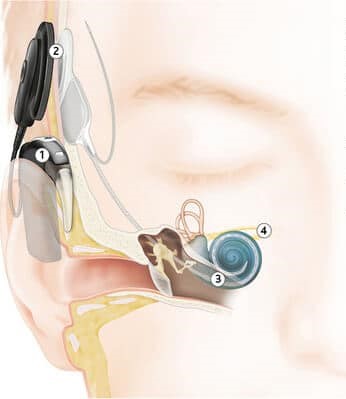 A cochlear implant is a surgically implanted device, which can provide useful hearing sensations by sending electrical signals to the nerve endings in the inner ear.