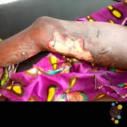 Bullous impetigo on leg of child