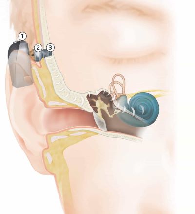 Bone conduction or bone anchored hearing aids (BCHA/BAHA).