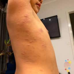 Eczema papules on body of child