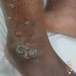 Bullous impetigo on ankle of child