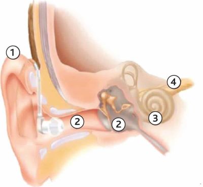 Behind the ear (BTE) or air conduction hearing aids.
